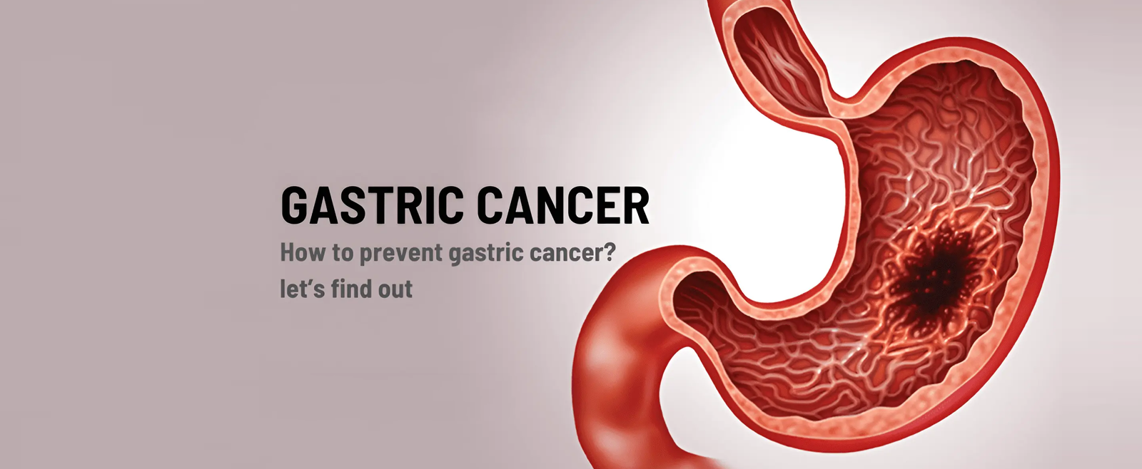 Stomach cancer Surgeon